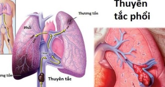 "Giải đáp" chi tiết về Đợt Cấp COPD và cách điều trị bệnh hiệu quả